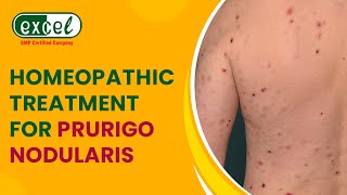 Prurigo Nodularis and Its Homeopathic Treatment  An Informative Video by Dr Anu Kant Goyal [upl. by Umont]