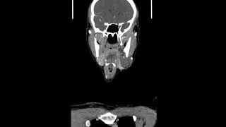 Submandibular Gland Arteriovenous Malformation with Phleboliths Coronal CT scans [upl. by Erdried]