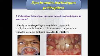 Cours Odontologie Conservatrice et Endodontie Deuxième Année Médecine Dentaire Partie 3 [upl. by Eruza618]