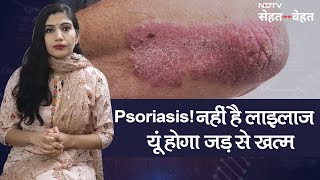 Psoriasis Causes Triggers Treatment and More  लाइलाज नहीं है सोराइसिस कैसे करें जड़ से खत्म [upl. by Adhern]