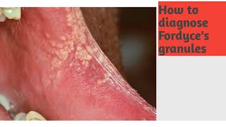 Fordyces Granules anatomy oral anatomy [upl. by Farkas]