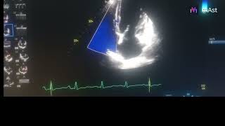 Global hypokinesia severe lv severe as mild mr [upl. by Kussell244]