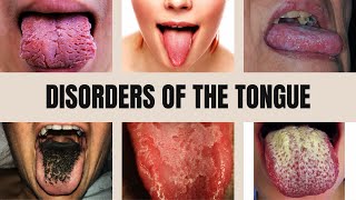 Tongue Diseases Geographic Tongue Black Hairy Tongue Glossitis Thrush and Leukoplakia [upl. by Hsitirb]