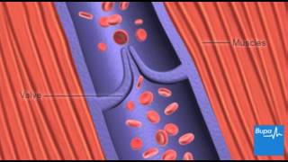 How deep vein thrombosis DVT forms  Bupa Health [upl. by Salba663]