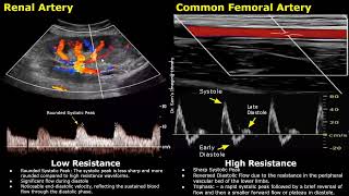 Difference Between Low Resistance amp High Resistance Waveforms On Spectral Doppler Ultrasound USG [upl. by Dnalyag]