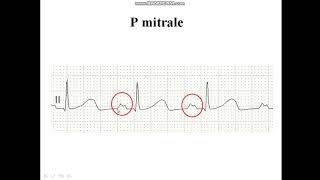 Pmitrale  Diagnosis of LAE [upl. by Eelyac994]