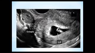 Heterotopic Pregnancy [upl. by Kirsti461]