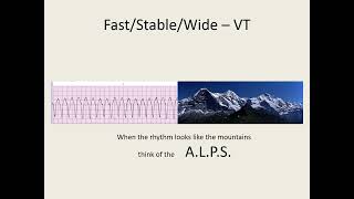 ACLS 2020 Algorithm Tachycardia [upl. by Lletnahc]