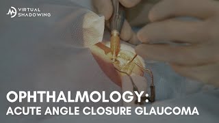 Virtual Shadowing Ophthalmology  Acute Angle Closure Glaucoma [upl. by Idhem627]