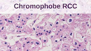 Chromophobe Renal Cell Carcinoma [upl. by Hannis]