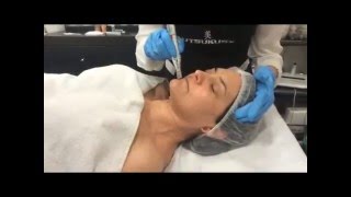 Tratamiento Facial Con Microagujas [upl. by Egiap]