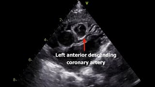 quot Coronary Arteries quot Usual amp Unsusual Echo Views [upl. by Barden]