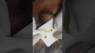 Sebaceous Hyperplasia Treatment with Lasers What You Need to Know [upl. by Atidnan]