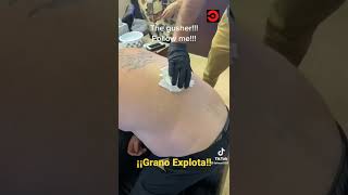 GRANO A PRESIÓN 😮granos espinillas tiktok viral reedit shorts [upl. by Charmaine]