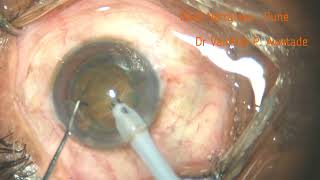 Phaco  Stop amp Chop  Multifocal IOL  Intravitreal Tricort Injection  040624 [upl. by Notnef804]