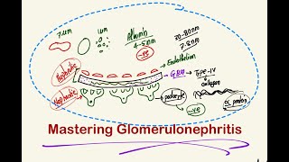 Calculative Glomerulonephritis [upl. by Surtemed449]