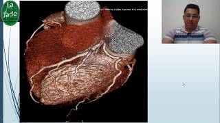 Angiotomografia de coronárias [upl. by Lacey978]