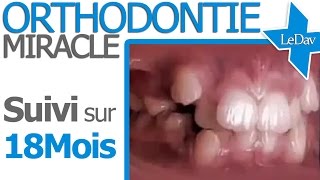 APPAREIL DENTAIRE Suivi Photo 18 MOIS  Traitement Orthodontie [upl. by Attezi]