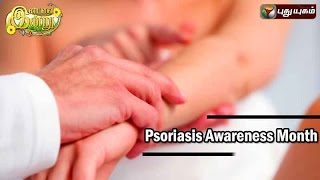 Psoriasis Awareness Month In Iniyavai Indru  13082016 I Puthuyugam TV [upl. by Nivak]