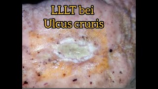 Ulcus Cruris Behandlung mit LLLT  HELBO Minilaser 3120 Anleitung Ulcus mit Laser behandeln [upl. by Anselm887]