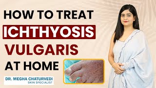 How to Treat Ichthyosis Vulgaris at Home  Home Remedies for Ichthyosis Vulgaris Fish Skin [upl. by Yael]