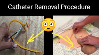 How To Remove Catheter With Scissors  Catheter Removal Procedure  How to Cut Catheter [upl. by Johna129]