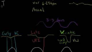 Electronic Fetal Monitoring [upl. by Steinke]