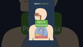 Recognizing the Signs of Pneumonia 🩺 MedicalEducation USMLE [upl. by Nerral203]