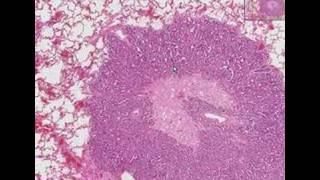 Histopathology LungMetastatic adenocarcinoma [upl. by Annay]