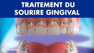 Gingivectomie  Traitement du sourire gingival © [upl. by Agem]