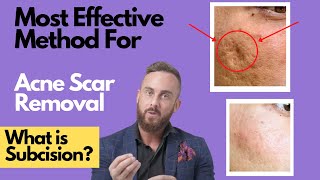 How To Treat DEEP ACNE SCARS  What is SUBCISION [upl. by Selwin551]