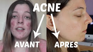 ACNE  Mon expérience et traitements naturels [upl. by Clemens]