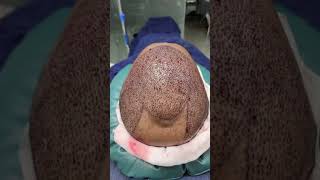 Hair Regrowth Treatment  টাক মাথায় চুল প্রতিস্থাপন চিকিৎসা [upl. by Hsirehc]