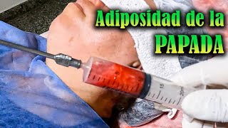 🔴 MINI LIPOSUCCIÓN en PAPADA  FUNCIONA 🤔 [upl. by Ogdon]