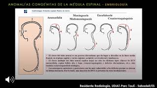 Malformaciones congénitas de la columna vertebral [upl. by Afihtan145]