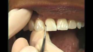 Periodoncia  Raspado [upl. by Derwon]