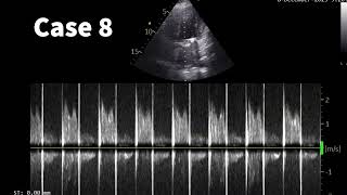 Unlock cardiac pathologies using CW Doppler [upl. by Coltson478]