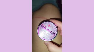 MY HONEST REVIEW SA SCARMINATOR CREAM [upl. by Jessica]