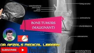 Bone tumors malignant  bone cancers [upl. by Ajim581]