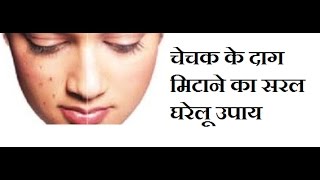 चेचक के दाग मिटाने के घरेलू उपाय Remove chickenpox scars easilyhome remedies for chickenpox scars [upl. by Hung]