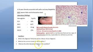 Pathology 272 a Iron deficiency anemia microcytic hypochromic RBC hemoglobin koilonychia case study [upl. by Nichola]