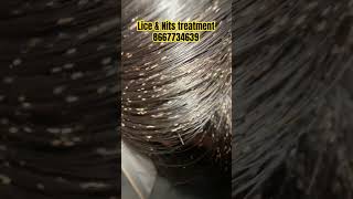 Lice Removallicehow to remove lice from headlice removal treatmentlice treatment in Coimbatore [upl. by Aidnama252]