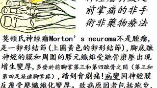 神經瘤Mortons neuroma引致足前掌痛的非手術非藥物療法 [upl. by Essirahc]