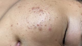 ACNE TREATMENT VU QUYNH MI  Perennial Blackheads On Boy Face 2024FULL [upl. by Sharos287]