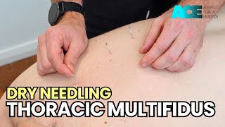 Dry Needling Thoracic Multifidus [upl. by Gershom227]