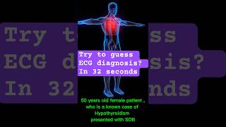 ecgdiagnosis hypothyroid hypothyroidism cardiology ecganalysis [upl. by Howey209]