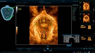 Auto Valoración ecográfica del suelo pelvico por 3D [upl. by Otinauj]