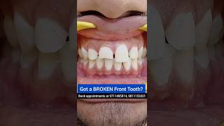 Got a BROKEN Front tooth Repair it today Dr Srishti Bhatia smilemakeover [upl. by Oberheim]