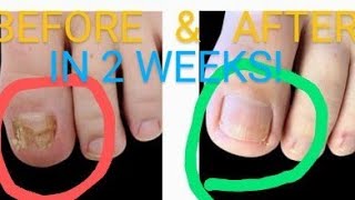 Kerasal  1 in Fungal Nail Removal Toenails amp Figure Nails IT WORKS HowTO Get Rid of Nail Fungus [upl. by Malda]