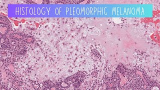 Histology of Pleomorphic adenoma [upl. by Cissie]